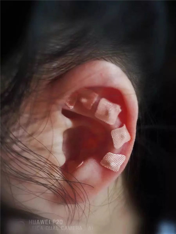 耳穴壓豆1.jpg 耳穴壓豆1.jpg