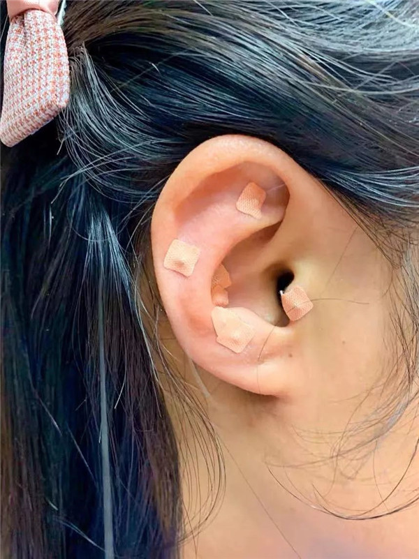 耳穴壓豆2.jpg 耳穴壓豆2.jpg