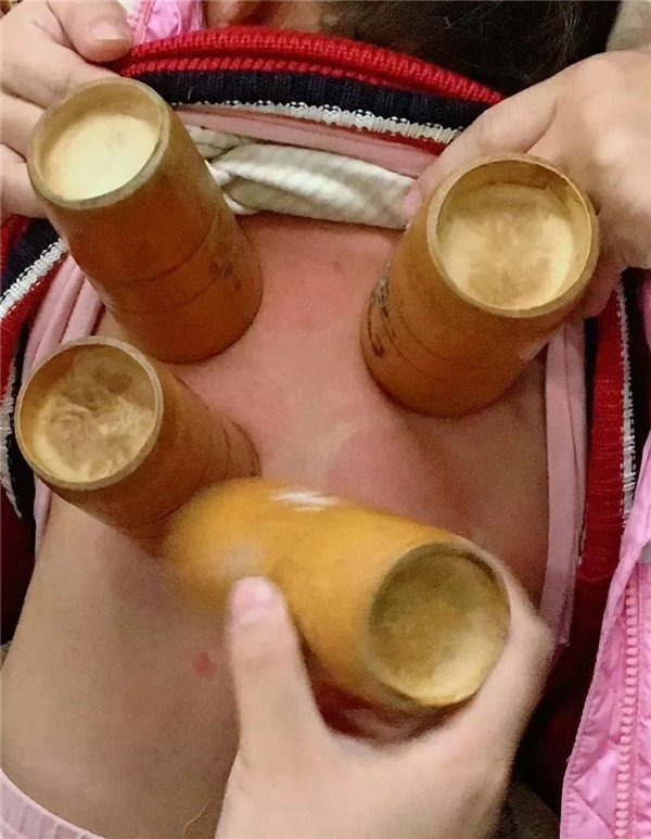 火罐.jpg 火罐.jpg